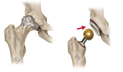 Эндопротезирование — индивидуальное планирование и современные эндопротезы