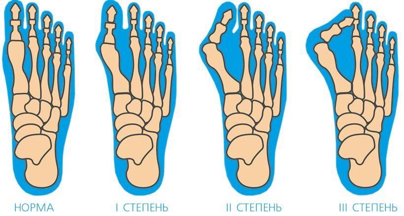 Хирургия стопы — оперативное лечение Hallux Valgus