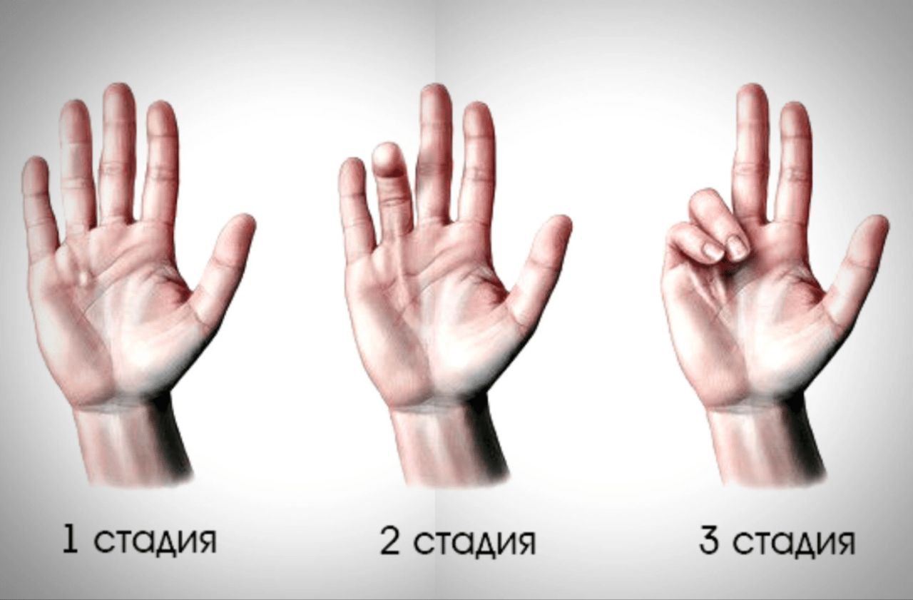 Хирургия кистей, запястья и предплечья, контрактура Дюпюитрена