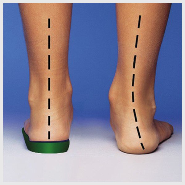 Индивидуальные ортопедические стельки — изготовление по слепку стопы